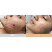 Omnilux Clear Medical-Grade LED Acne Mask