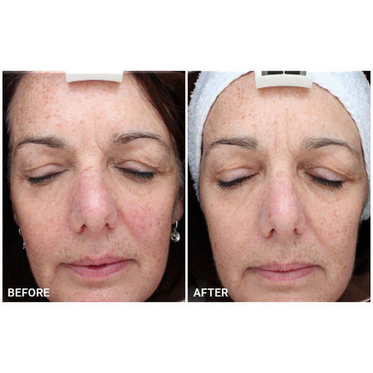 Omnilux Contour FACE: Medical-Grade LED Antiaging Mask